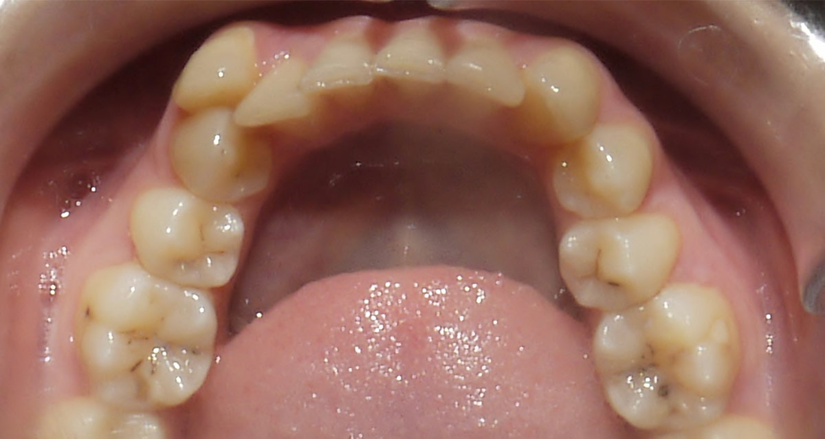 images/kieferorthopaedie/03-kieferorthopaedie_vorher3.jpg#joomlaImage://local-images/kieferorthopaedie/03-kieferorthopaedie_vorher3.jpg?width=1200&height=639