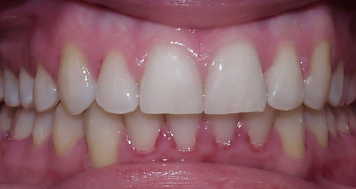 images/kieferorthopaedie/04-kieferorthopaedie_nachher4.jpg#joomlaImage://local-images/kieferorthopaedie/04-kieferorthopaedie_nachher4.jpg?width=1200&height=639