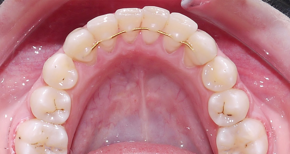 images/kieferorthopaedie/06-kieferorthopaedie_nachher6.jpg#joomlaImage://local-images/kieferorthopaedie/06-kieferorthopaedie_nachher6.jpg?width=1200&height=639